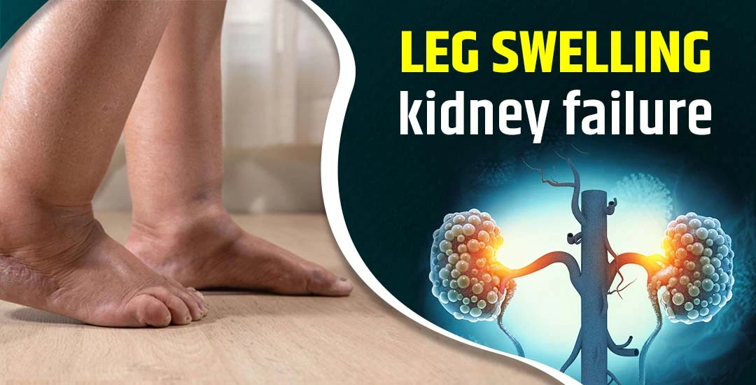 How to Manage Leg Swelling Caused by Kidney Failure?